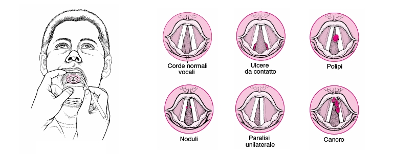 Disfonia